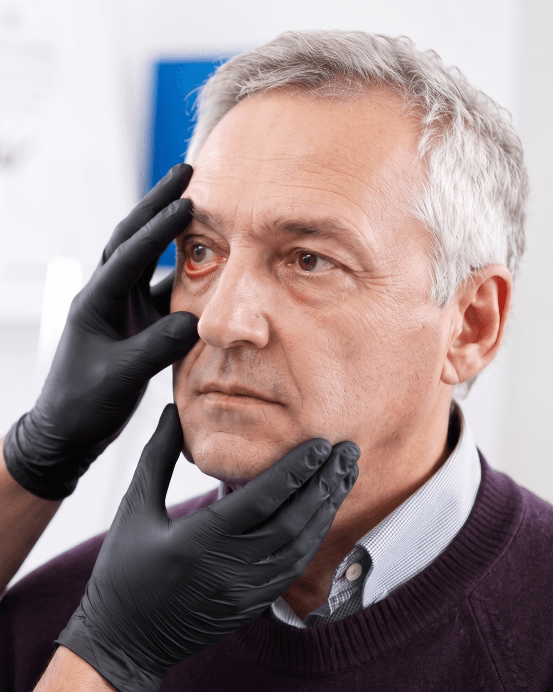 Expert ectropion surgery to restore eyelid comfort at The Eye Doctor in Huddersfield