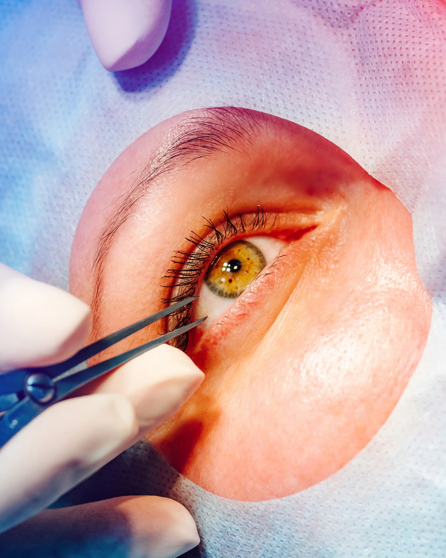 Laser Vision Correction