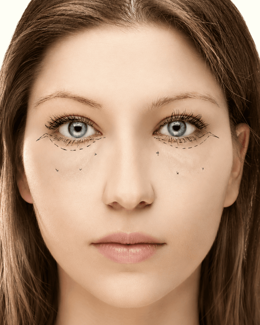 Expert lower blepharoplasty to refresh tired eyes at The Eye Doctor in Huddersfield