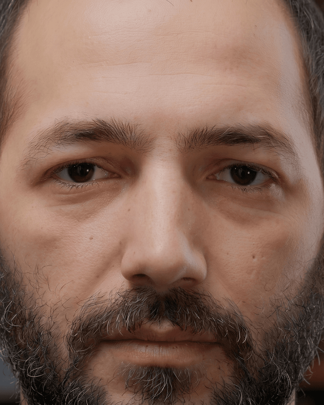 Expert upper blepharoplasty to refresh tired eyes at The Eye Doctor in Huddersfield