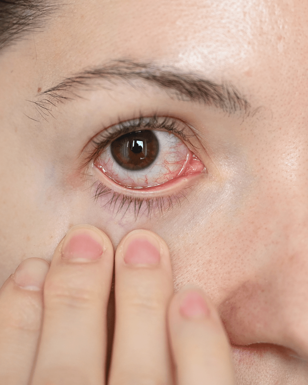Specialist uveitis and ocular inflammation treatment at The Eye Doctor in Huddersfield