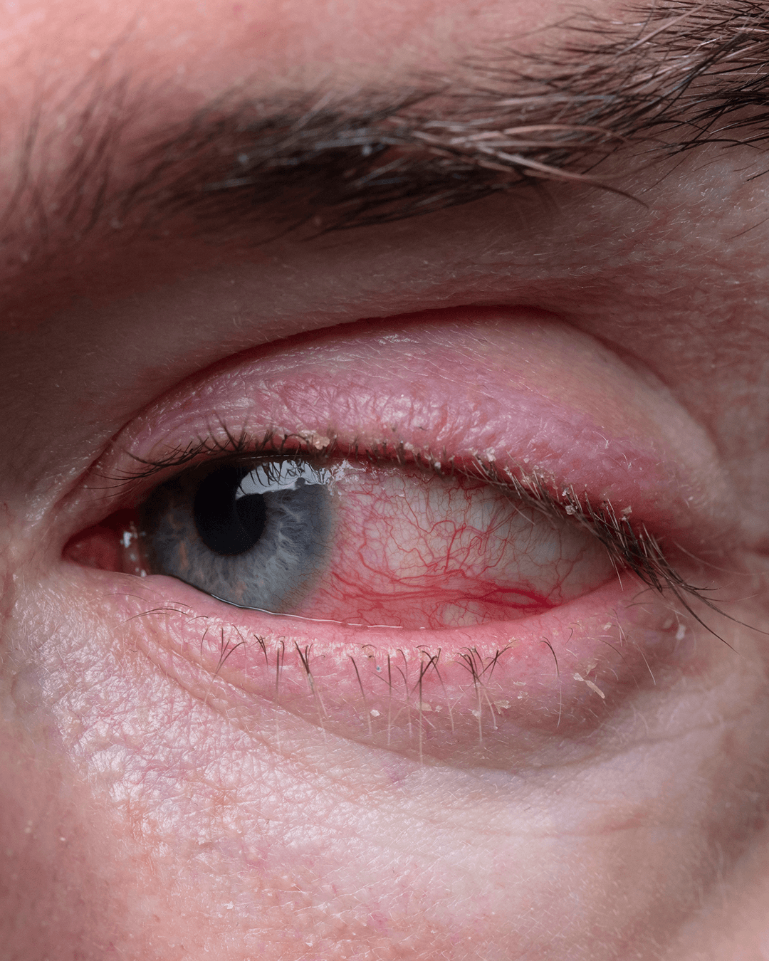 Uveitis treatment procedure overview