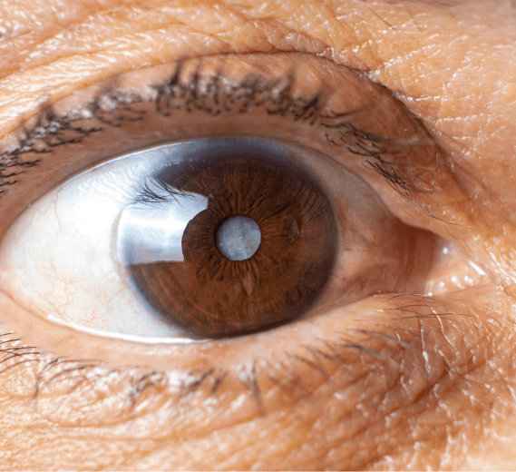 Glaucoma medical management with prescription eye drops